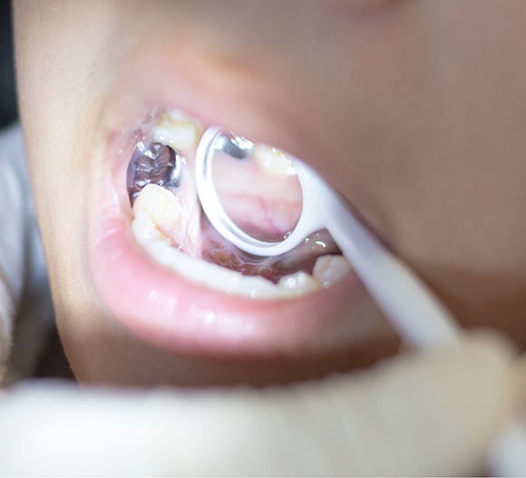 Close up of a dental mirror inside of a mouth with silver fillings