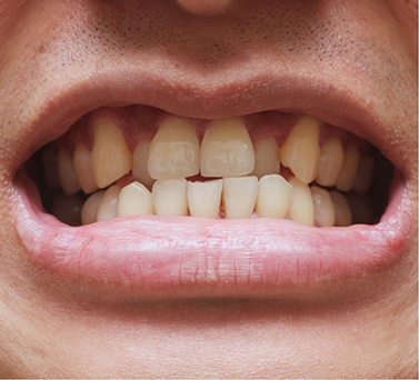 Close up of a mouth with crowded teeth