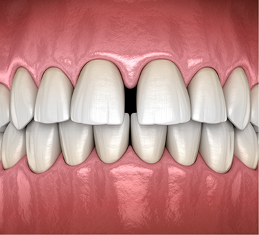 Illustrated mouth with gapped front teeth