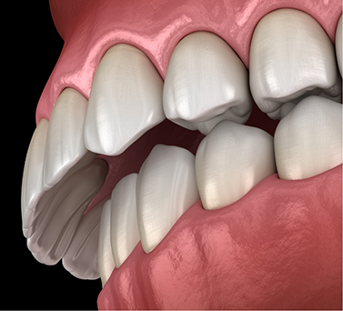 Illustrated mouth with an overbite
