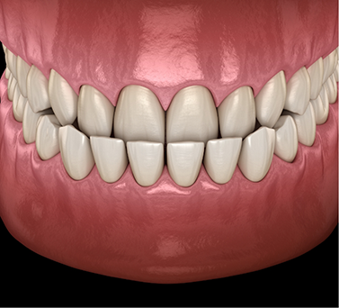 Illustrated mouth with an underbite