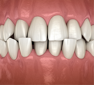 Illustrated mouth with a crossbite