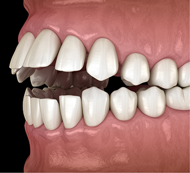 Illustrated mouth with an open bite