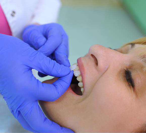 Cosmetic dentist placing a veneer over a patient's tooth