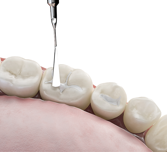 Illustration of a dental instrument touching a tooth
