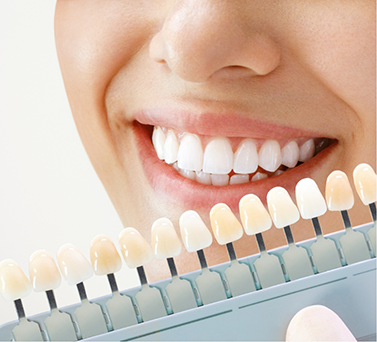 Shade guide next to a flawless smile