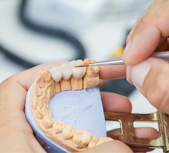 Dental professional designing a dental bridge