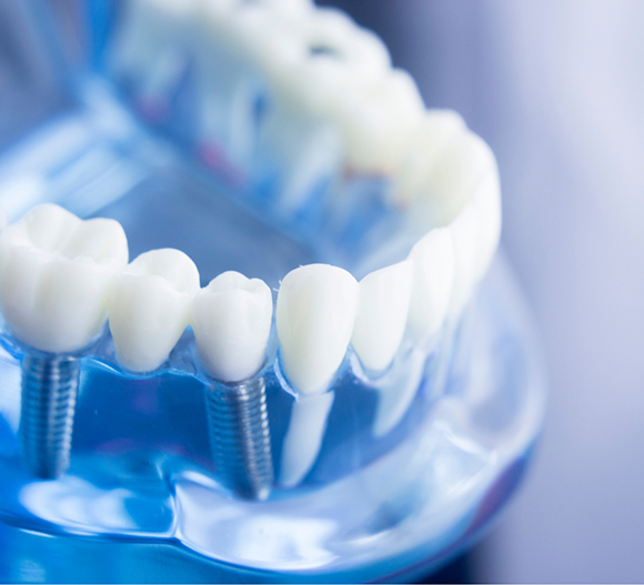 Model of the mouth with two dental implants in Doylestown