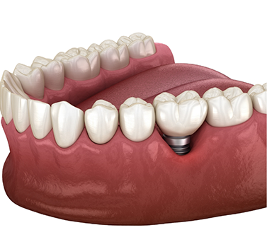 Illustrated dental implant with a crown replacing a missing tooth
