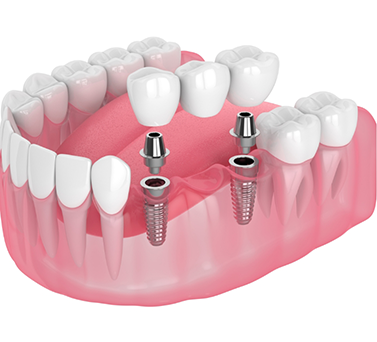 Illustrated dental bridge being placed onto two dental implants
