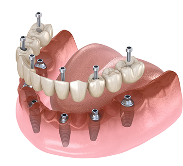 Illustrated denture being placed onto six dental implants