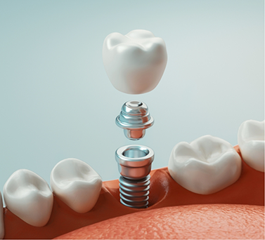 Illustration of a dental implant and crown being placed in the jawbone