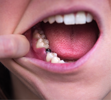 Close up of a mouth with a visible dental implant abutment