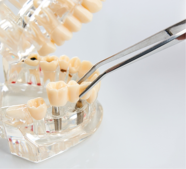 Tweezers placing a dental bridge over a model of the mouth with dental implants