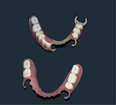 Two partial dentures