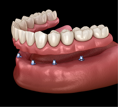 Illustration of an implant denture