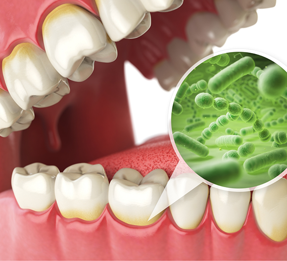 Illustration of a mouth infected with gum disease