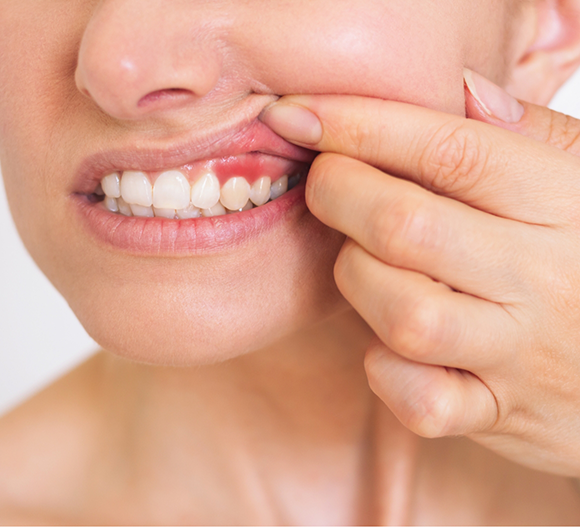 Woman pointing to a red spot in her gums