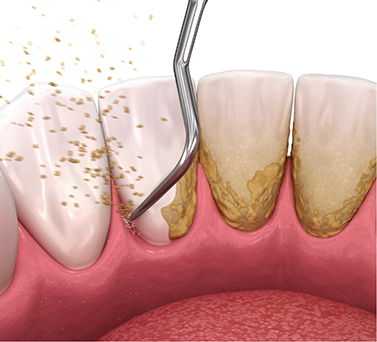Illustration of a dental scaler removing tartar from the teeth