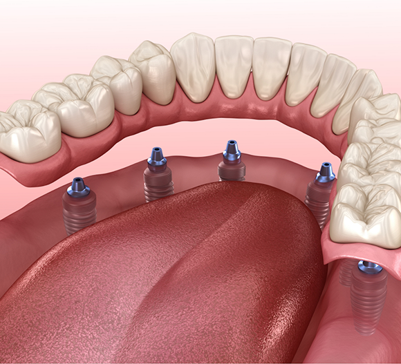 Illustration of an implant denture in Doylestown