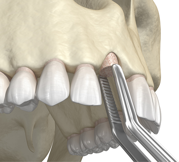 Illustration of a bone graft in the upper jaw
