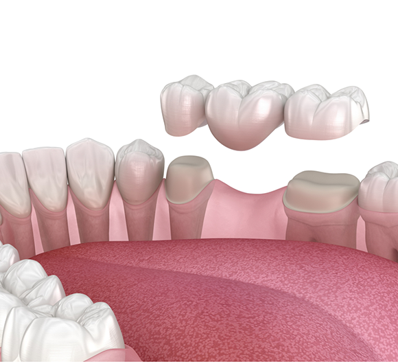 Illustration of a dental bridge replacing a missing tooth