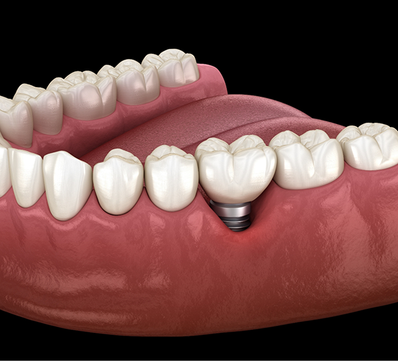 Illustration of a dental implant with a crown replacing a missing tooth