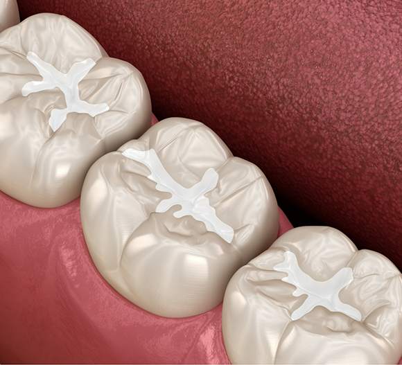 Illustration of teeth with white fillings