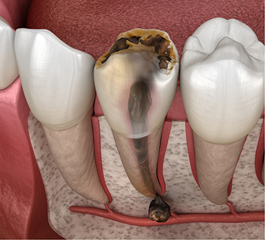 Illustration of a decayed and damaged tooth