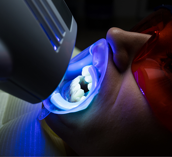 Dental patient getting professional teeth whitening in the treatment chair