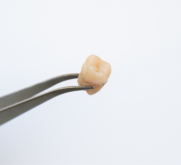 Tweezers holding an extracted tooth