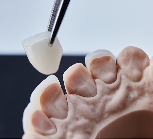 Tweezers placing a veneer over a model of a tooth