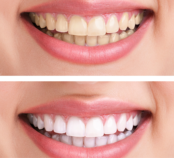 Close up of a smile before and after whitening the teeth