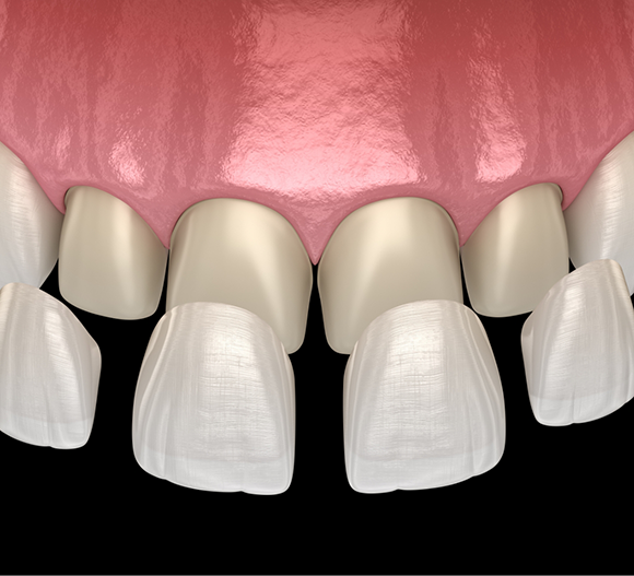 Illustration of veneers being placed over a row of teeth