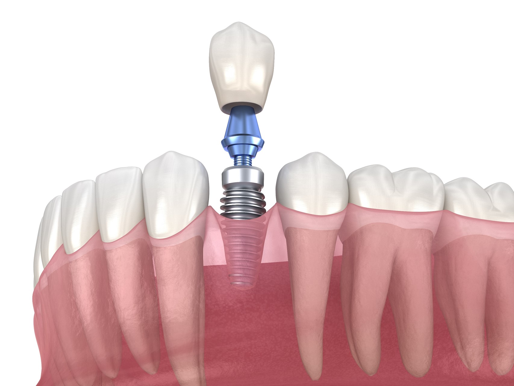 Model of dental implant components.