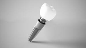 3D render of a dental implant.