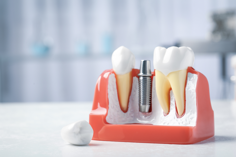 A closeup of a model of dental implants.