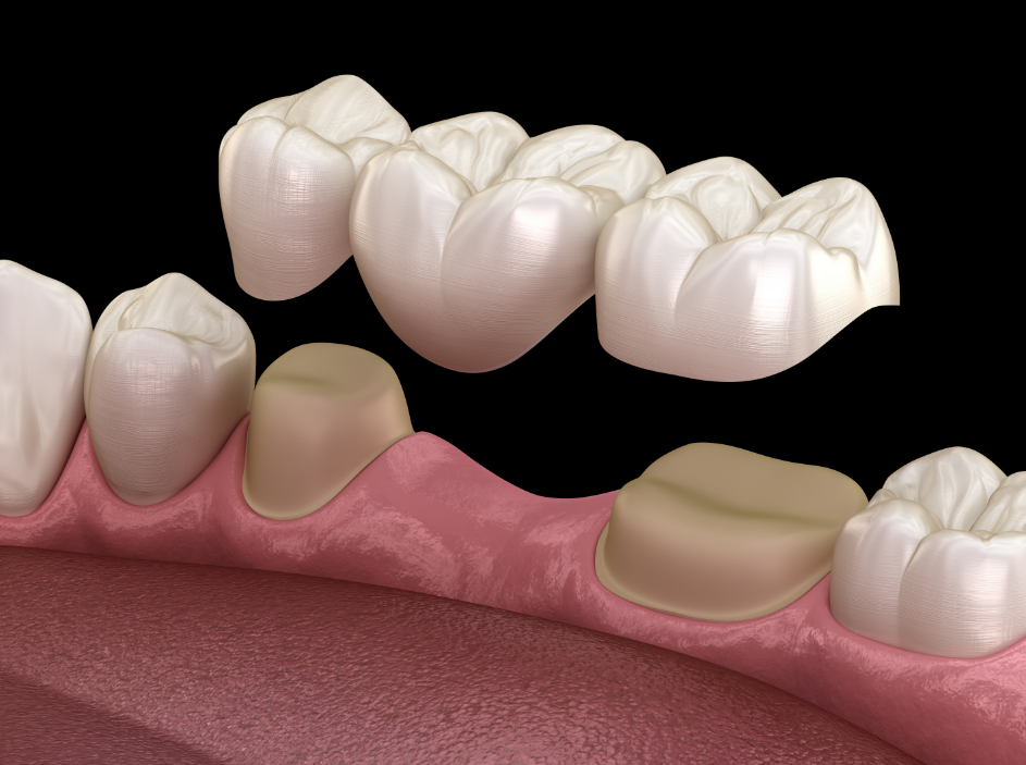 Dental bridge illustration with three pontics set to fit over two shaped teeth.