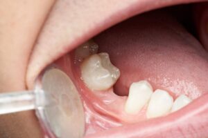 Close-up of mouth with missing tooth. 