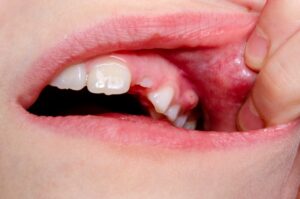Person moving lip to show bump on their upper gum. 